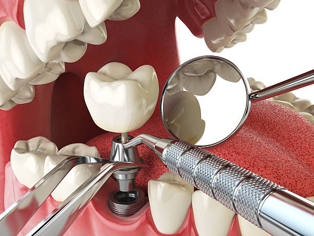 Best Urgent Care for Lost Fillings or Crowns in Newport, MN
